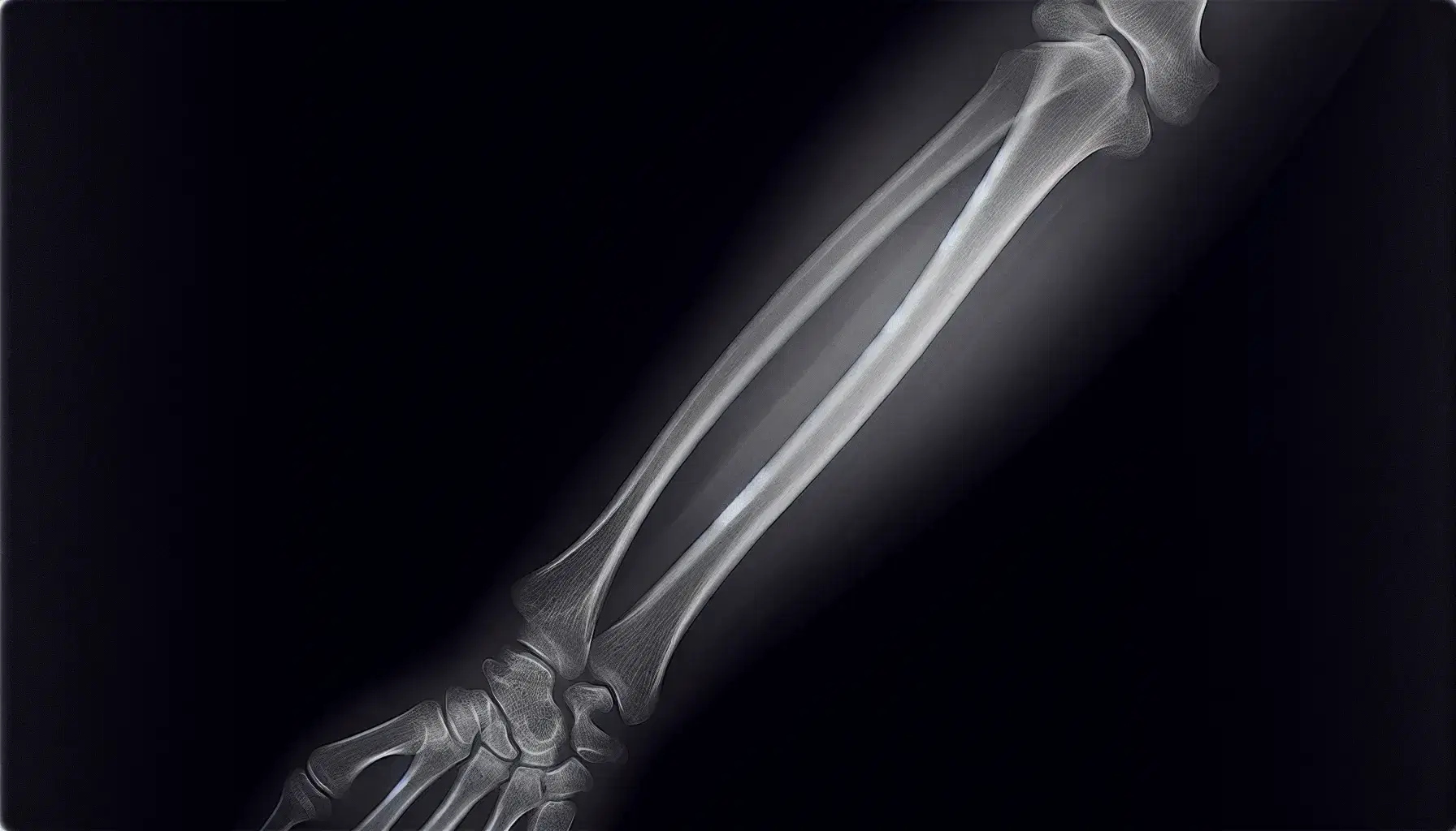 Radiografía de antebrazo humano mostrando fractura transversal en uno de los huesos, con detalle de la discontinuidad ósea y tejidos circundantes.