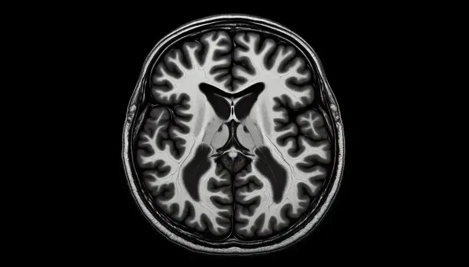 Resonancia magnética cerebral mostrando sección transversal con estructuras cerebrales en distintos tonos de gris, ventrículos oscuros y materia blanca y gris resaltada.