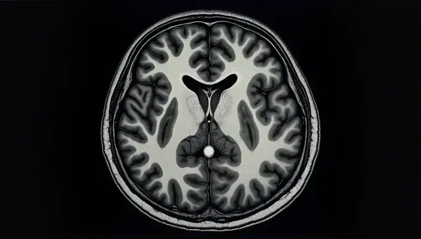 Resonancia magnética cerebral mostrando sección transversal con áreas de distintas densidades y una zona blanca central que sugiere una anomalía.