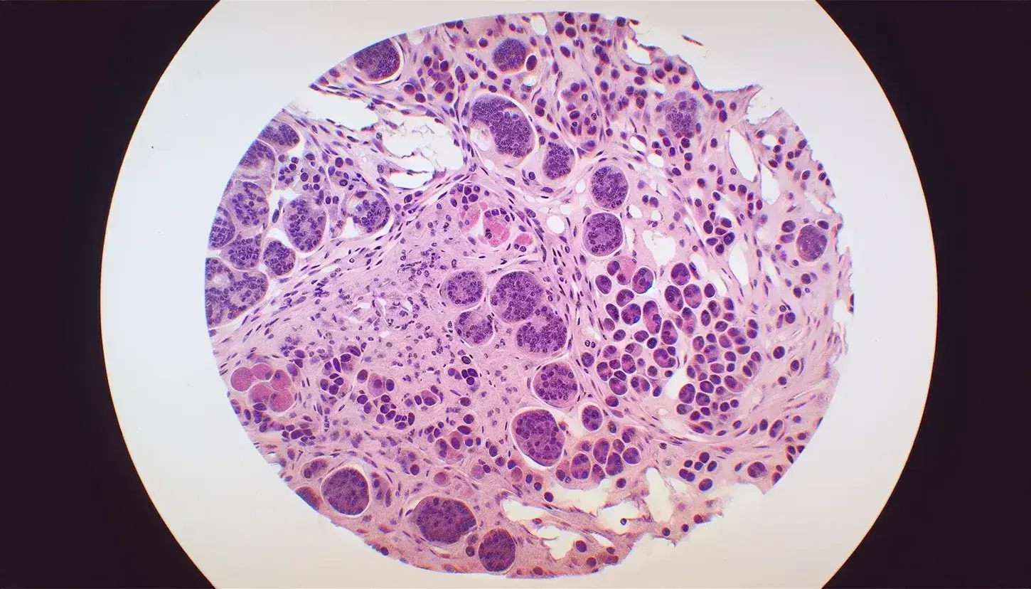 Vista microscópica de tejido linfoide con células teñidas en tonos de morado y rosa, mostrando núcleos oscuros y estructura celular densa.