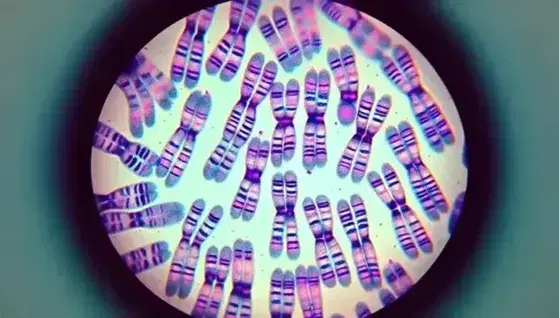 Cariotipo umano colorato al microscopio, con cromosomi appaiati e bandeggiati in tonalità rosa-viola su sfondo chiaro.